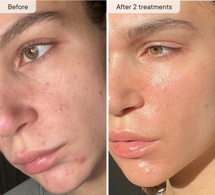 Refresh the look of dull skin with the Micro-Infusion Facial System Brightening