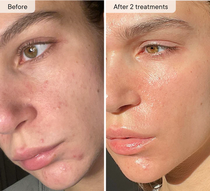 Refresh the look of dull skin with the Micro-Infusion Facial System Brightening