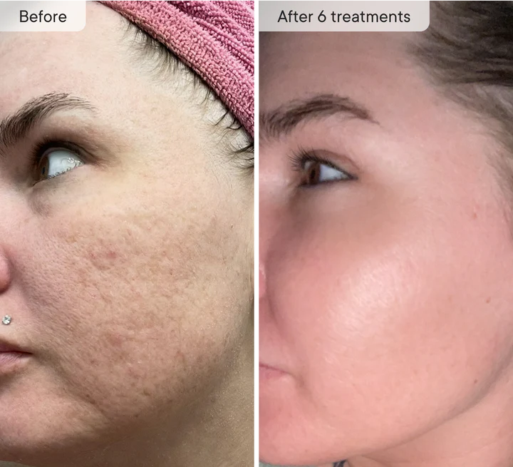 Refresh the look of dull skin with the Micro-Infusion Facial System Brightening