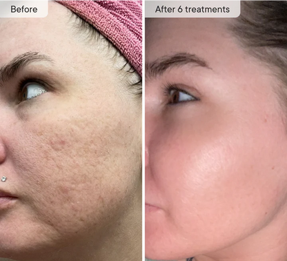 Refresh the look of dull skin with the Micro-Infusion Facial System Brightening