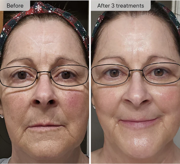 Refresh the look of dull skin with the Micro-Infusion Facial System Brightening