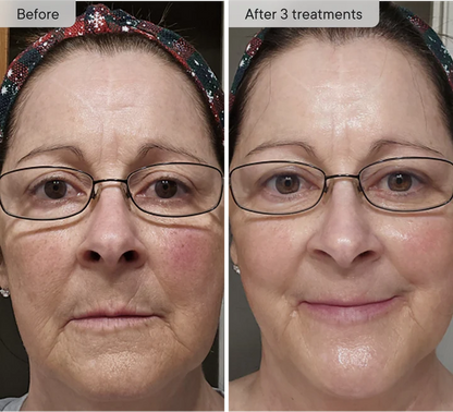 Refresh the look of dull skin with the Micro-Infusion Facial System Brightening